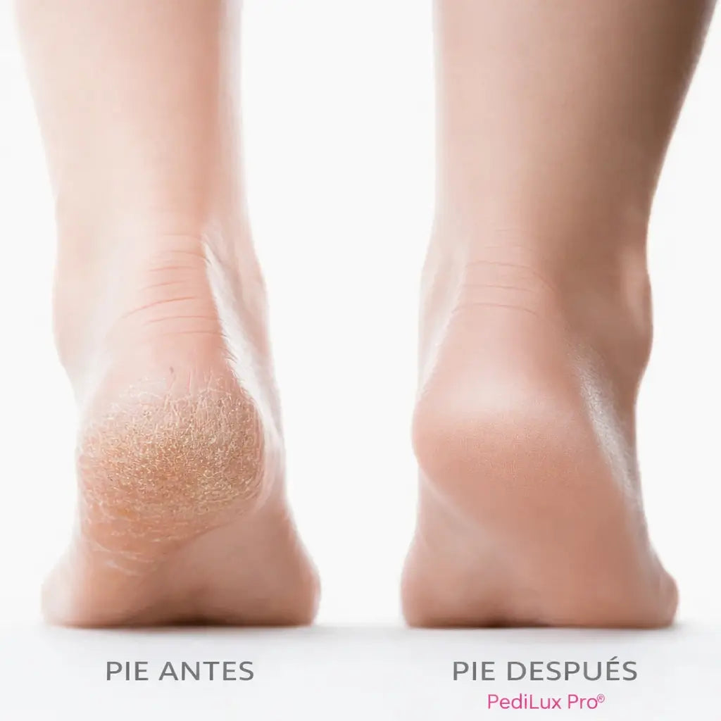 PediLux Pro® – Talones suaves sin esfuerzo