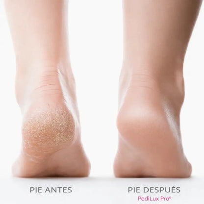 PediLux Pro® – Talones suaves sin esfuerzo